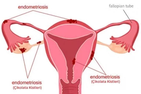 Endometriozis (Çikolata Kisti) Nedir? Hangi Tedaviler Uygulanır?